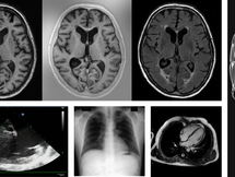Diagnosis of COVID-19 using CXRs and CT scans